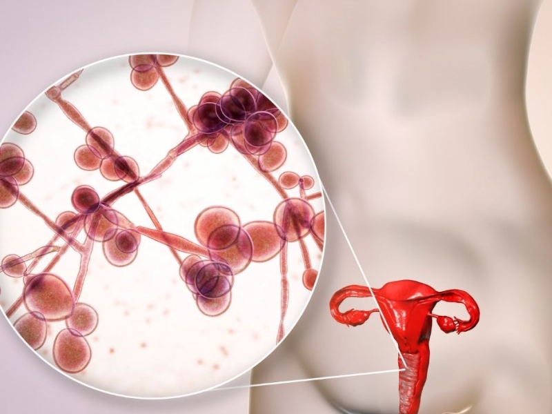 There are several options for treating yeast infections.