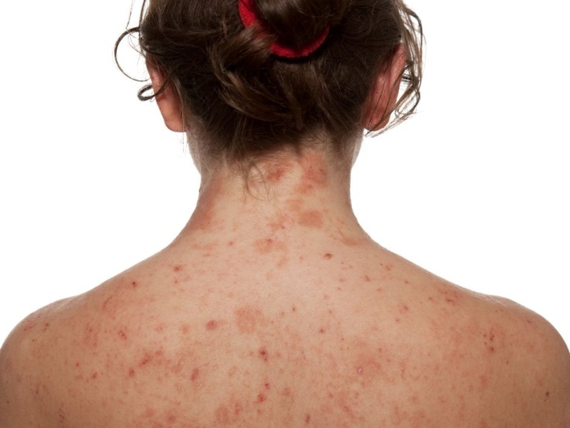 What To Do If You Have Contact Dermatitis