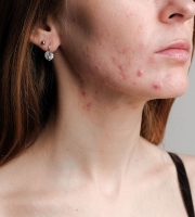 Acne: The World's Greatest Teenager Problem